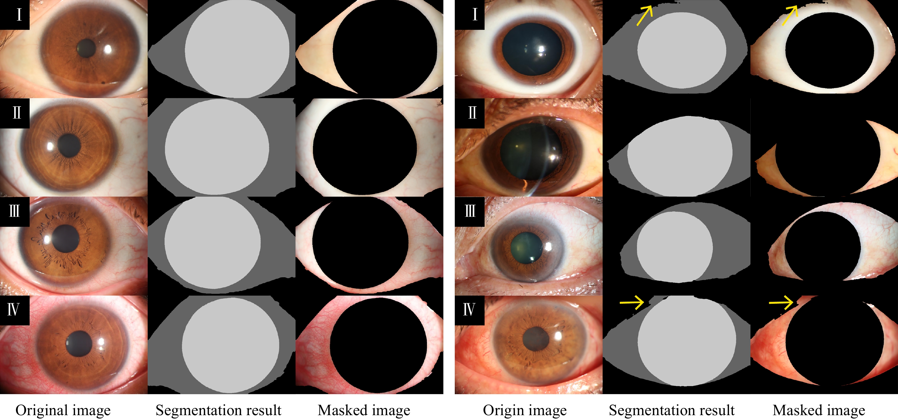 Mask Distillation Network For Conjunctival Hyperemia Severity